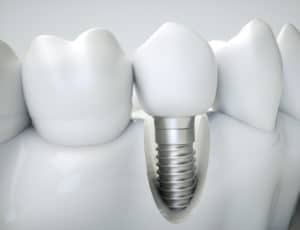 dental implants