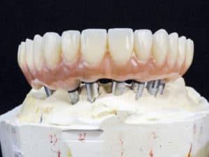 stablized denture implants