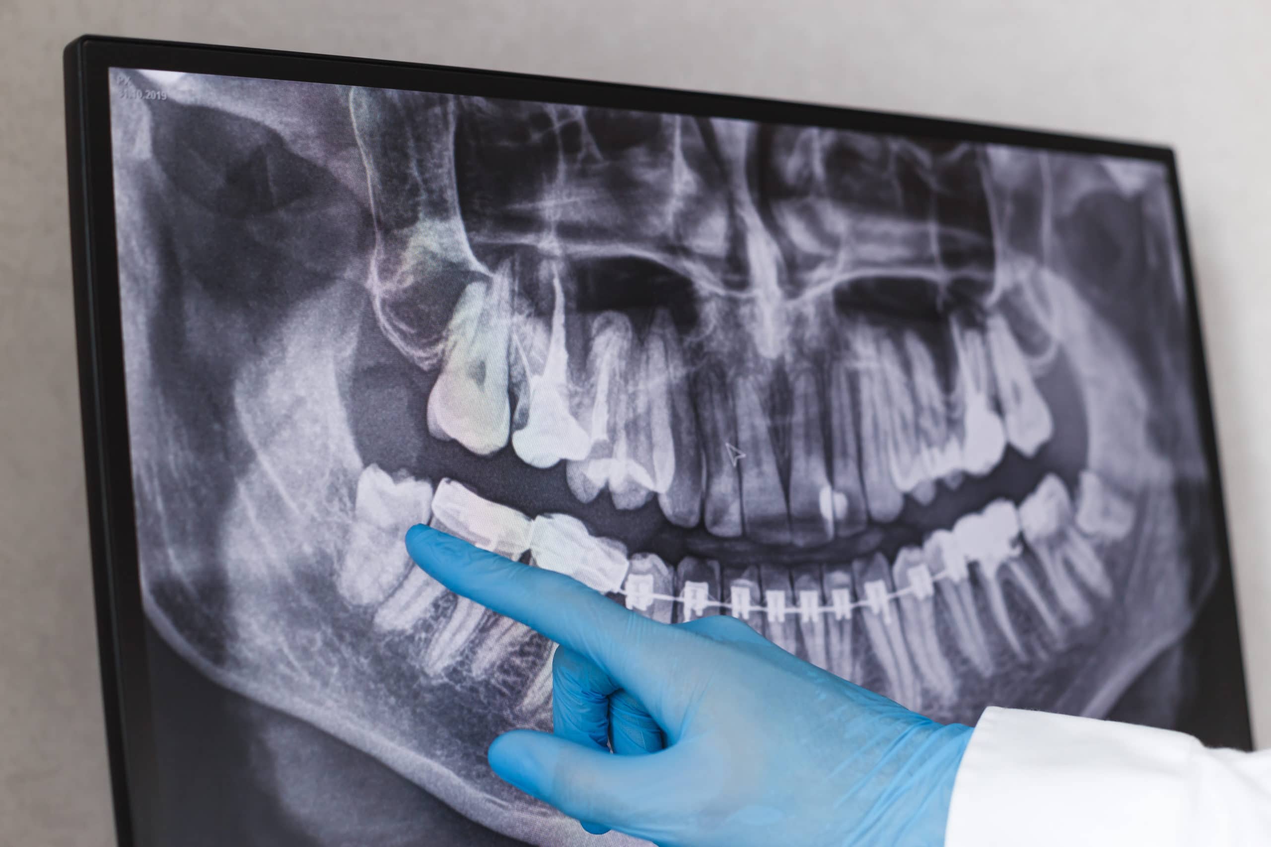 Dental X-rays