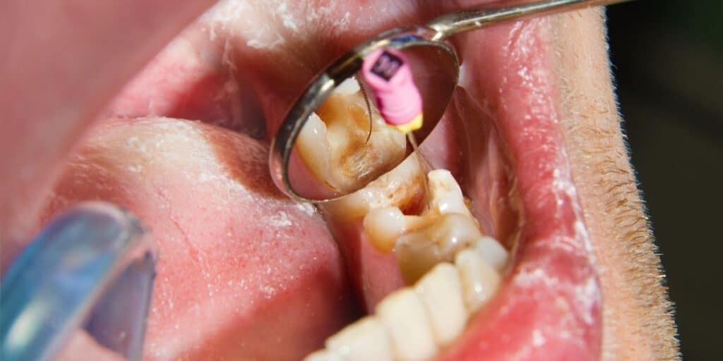 root canal treatment in Stafford, VA