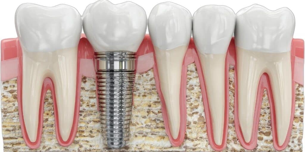 dental implants treatment by dentist in Woodbridge VA