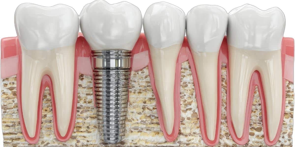 dental implants treatment by dentist in Woodbridge VA