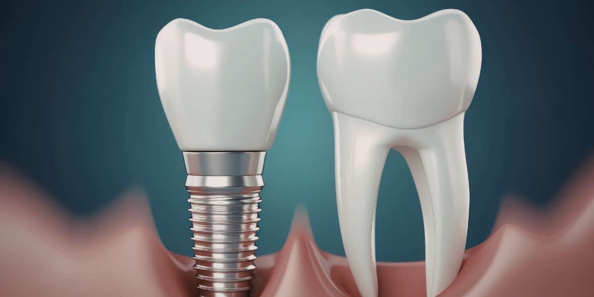 Dental implants in Fredericksburg, VA at New Smiles Dental